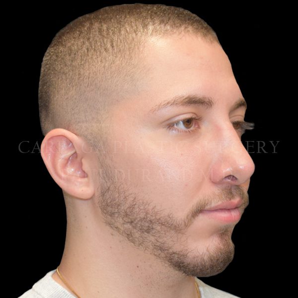 Rhinoplasty result at Careaga Plastic Surgery