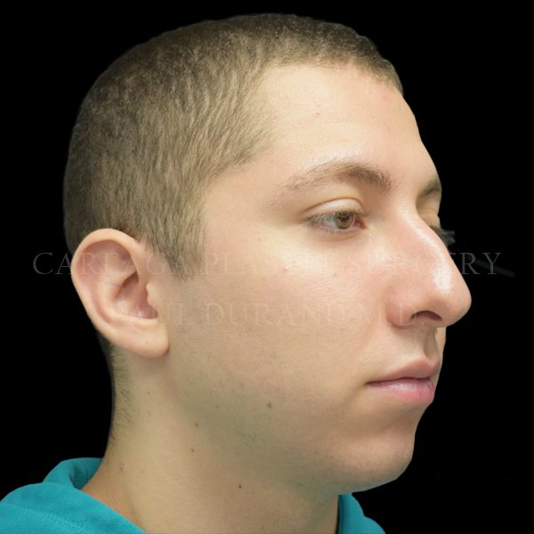 Rhinoplasty before photo