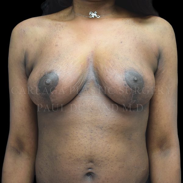 Breast Lift result at Careaga Plastic Surgery