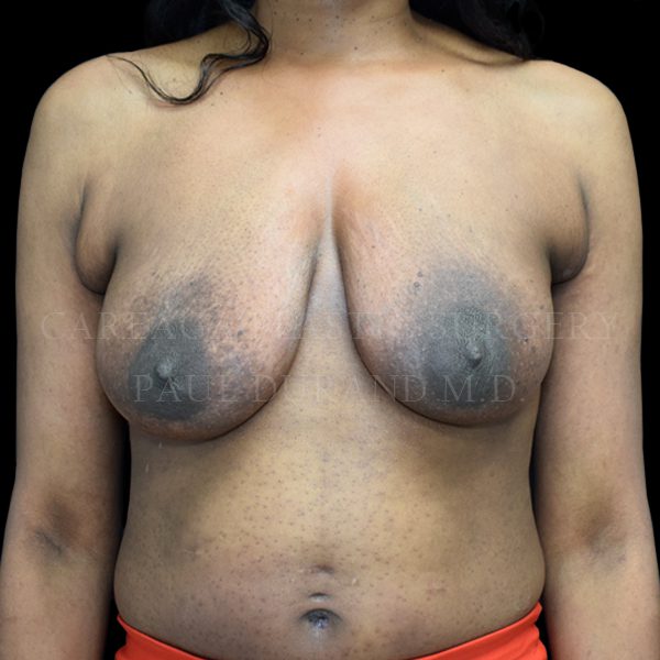Breast Lift before photo
