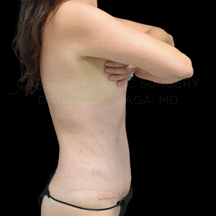 Tummy Tuck result at Careaga Plastic Surgery