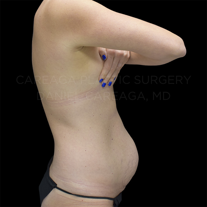 Tummy Tuck before photo