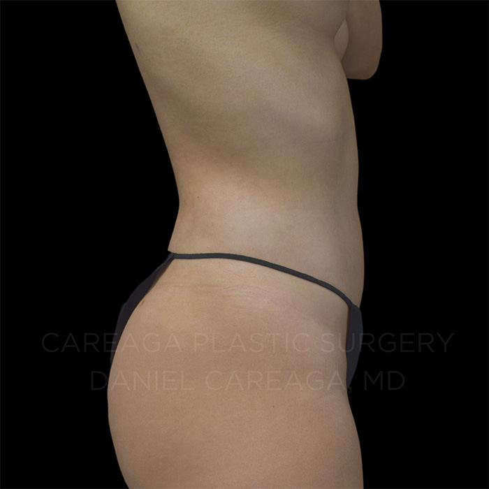 Liposuction result at Careaga Plastic Surgery