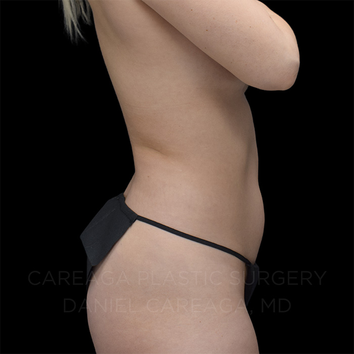 Liposuction before photo
