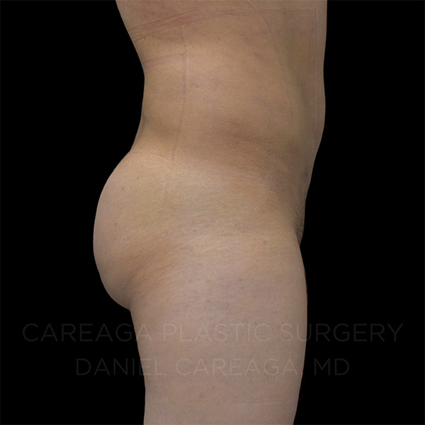 Bbl result at Careaga Plastic Surgery