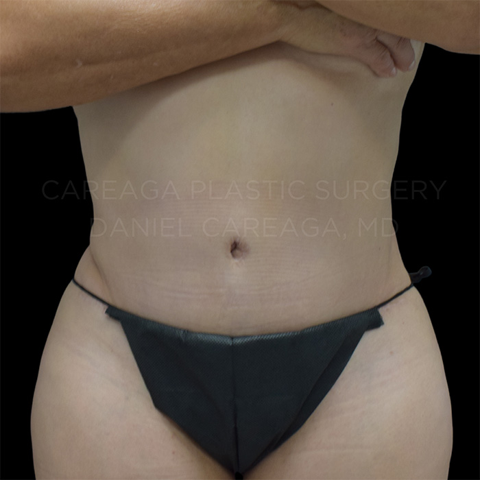 Tummy Tuck result at Careaga Plastic Surgery