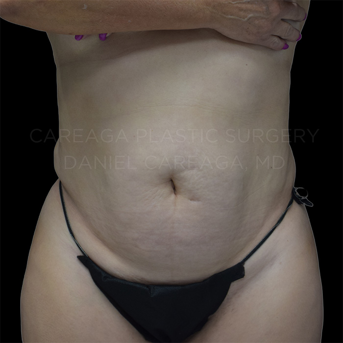 Tummy Tuck before photo