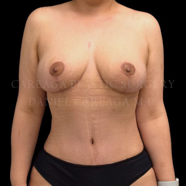 Mommy Makeover result at Careaga Plastic Surgery
