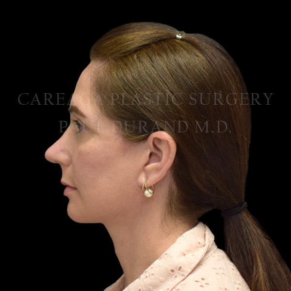 Rhinoplasty result at Careaga Plastic Surgery