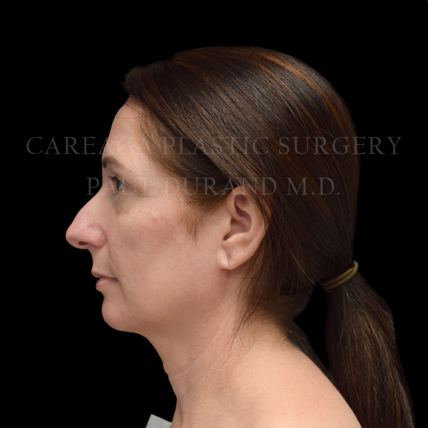 Rhinoplasty before photo