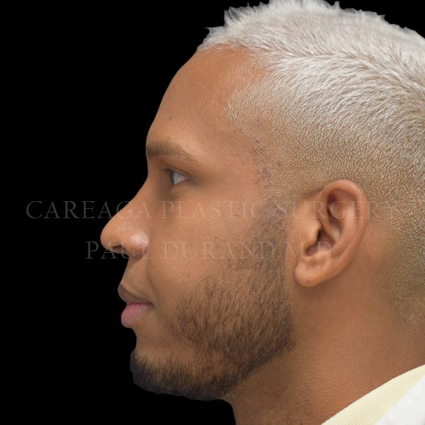 Rhinoplasty result at Careaga Plastic Surgery