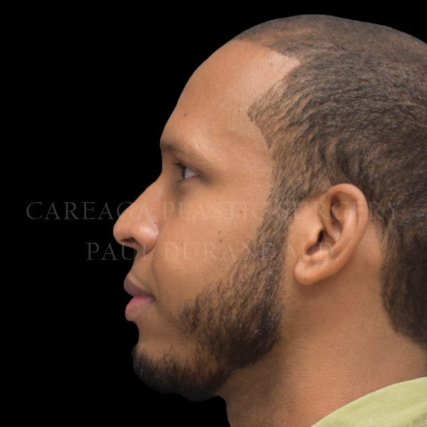 Rhinoplasty before photo