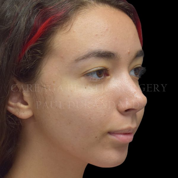 Rhinoplasty result at Careaga Plastic Surgery