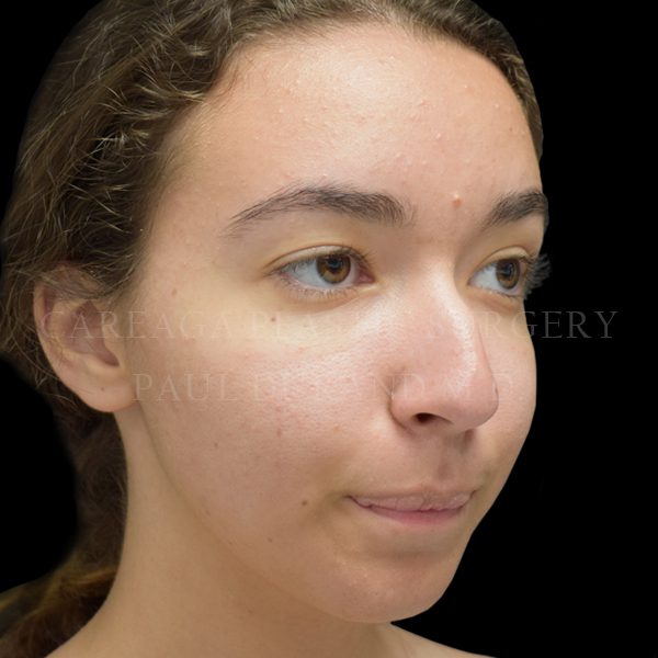 Rhinoplasty before photo