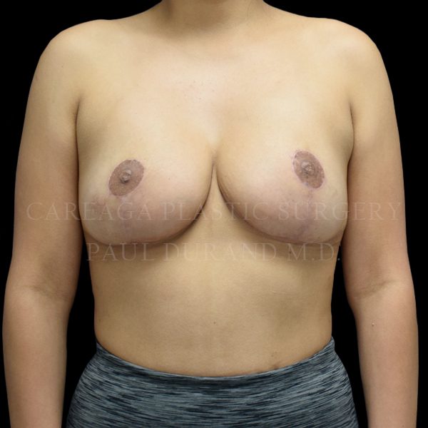 Breast Reduction result at Careaga Plastic Surgery