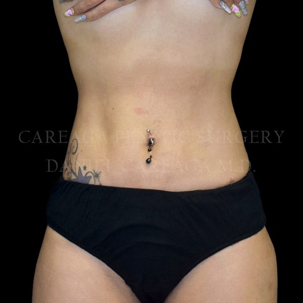 Liposuction result at Careaga Plastic Surgery
