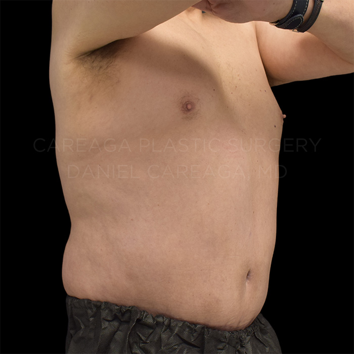 Tummy Tuck result at Careaga Plastic Surgery