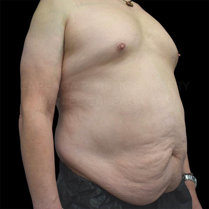 Tummy Tuck before photo
