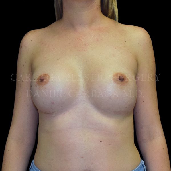 Breast Augmentation result at Careaga Plastic Surgery