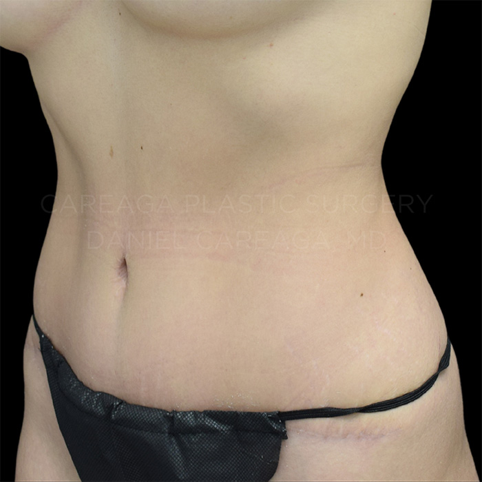 Tummy Tuck result at Careaga Plastic Surgery