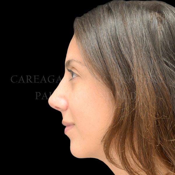 Rhinoplasty result at Careaga Plastic Surgery