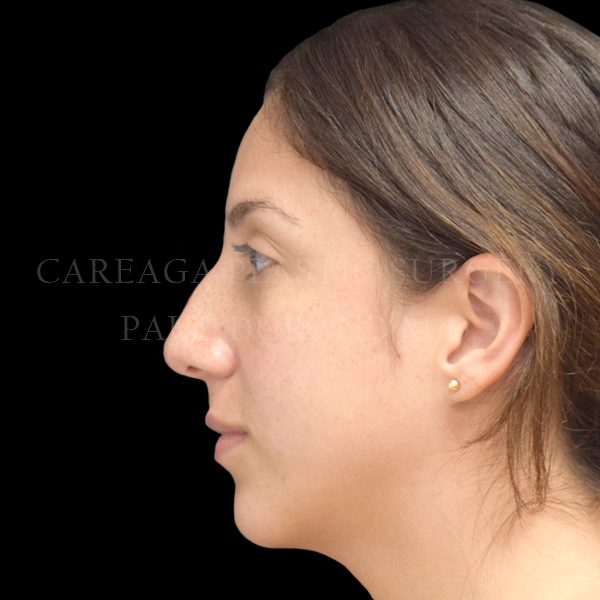 Rhinoplasty before photo