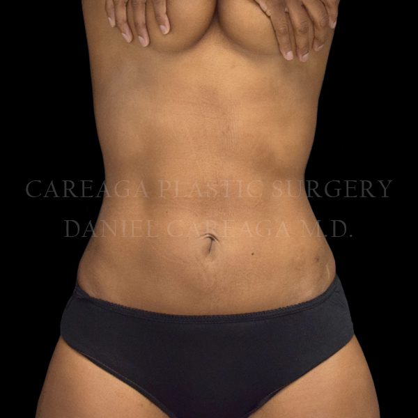 Liposuction result at Careaga Plastic Surgery
