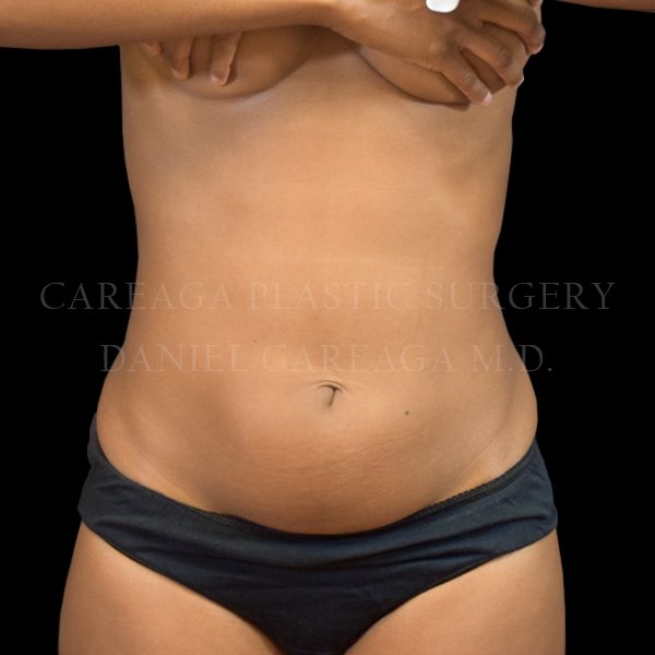 Liposuction before photo