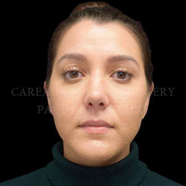 Rhinoplasty result at Careaga Plastic Surgery