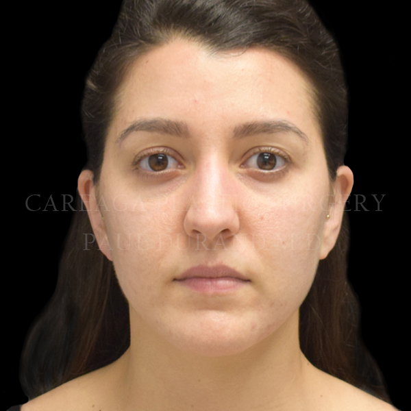 Rhinoplasty before photo