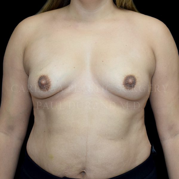 Breast Augmentation before photo