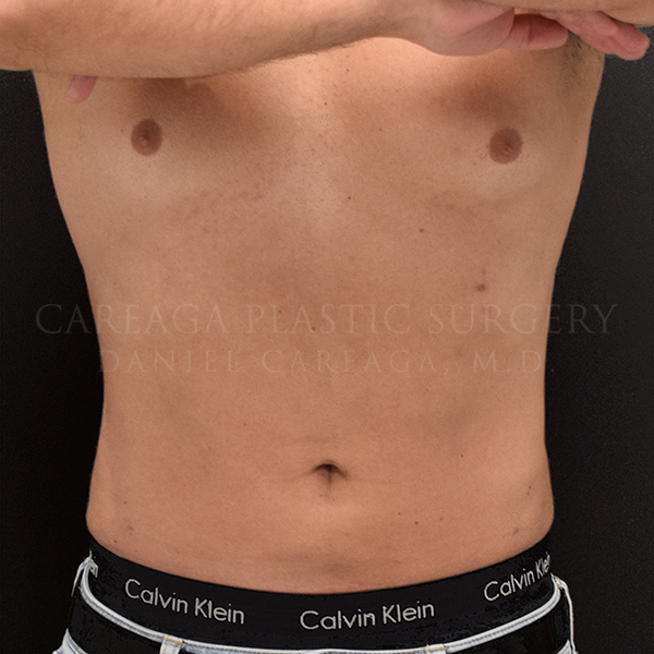 Liposuction result at Careaga Plastic Surgery