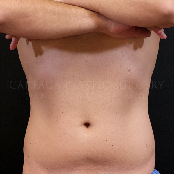 Liposuction before photo