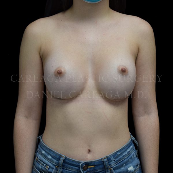 Breast Augmentation result at Careaga Plastic Surgery