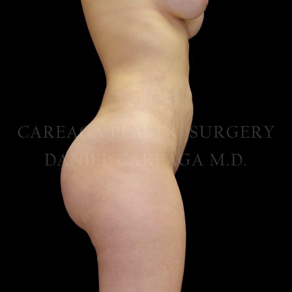 Bbl result at Careaga Plastic Surgery