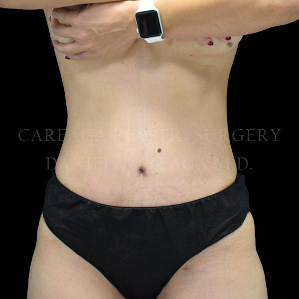 Tummy Tuck result at Careaga Plastic Surgery