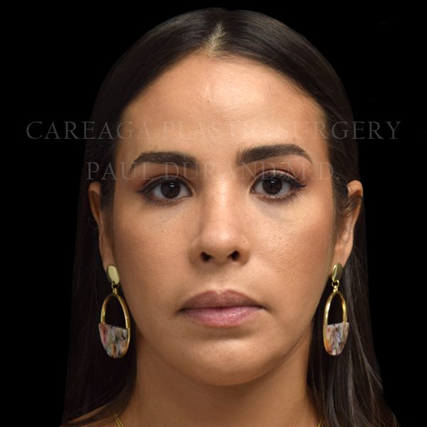 Rhinoplasty result at Careaga Plastic Surgery