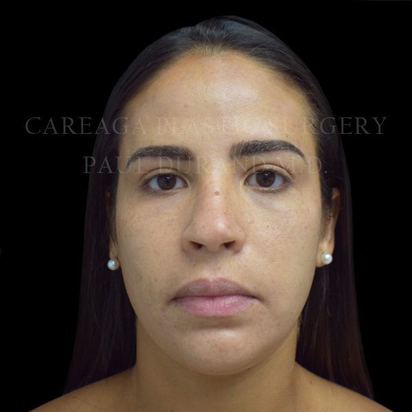 Rhinoplasty before photo