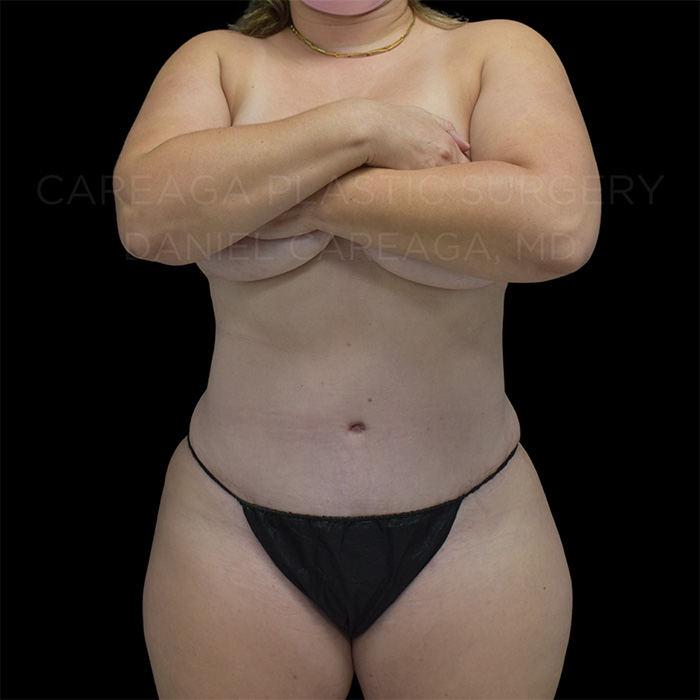 Tummy Tuck result at Careaga Plastic Surgery