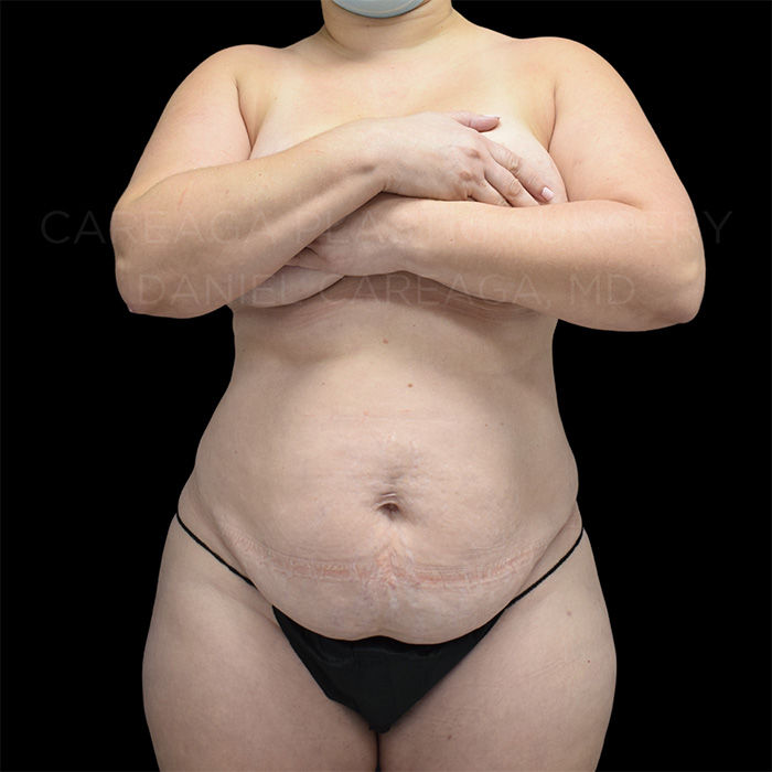 Tummy Tuck before photo