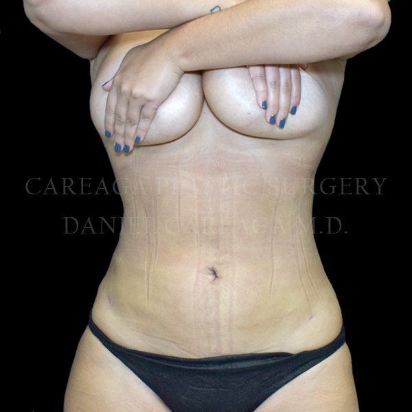 Liposuction result at Careaga Plastic Surgery