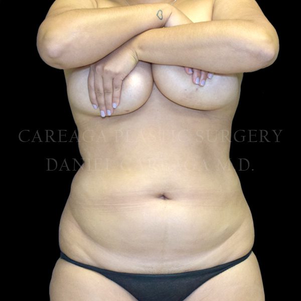 Liposuction before photo