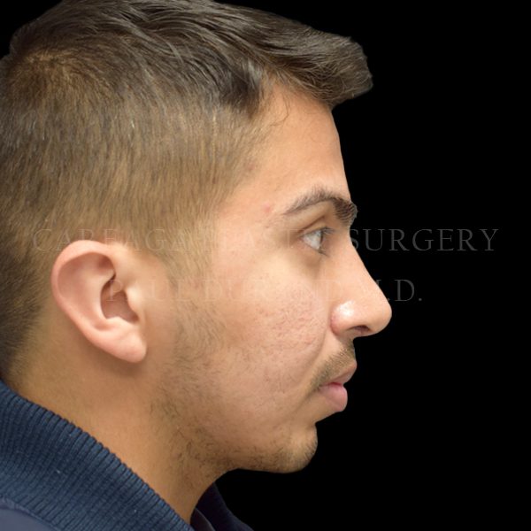 Rhinoplasty result at Careaga Plastic Surgery