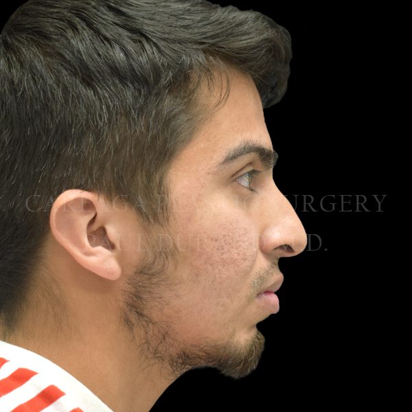 Rhinoplasty before photo