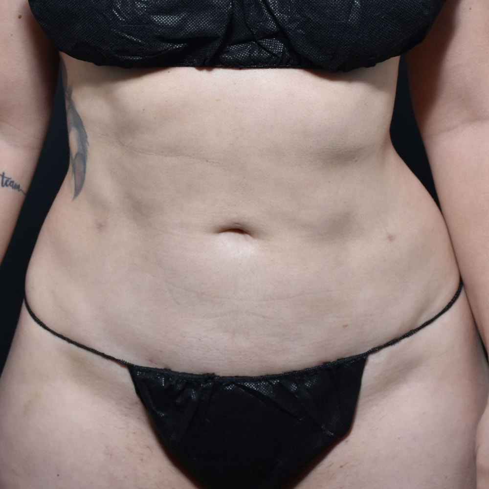 A result from Burgess Plastic Surgery and MedSpa