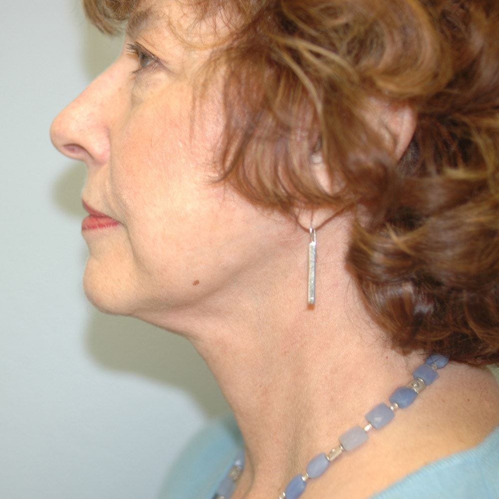 A result from Burgess Plastic Surgery and MedSpa