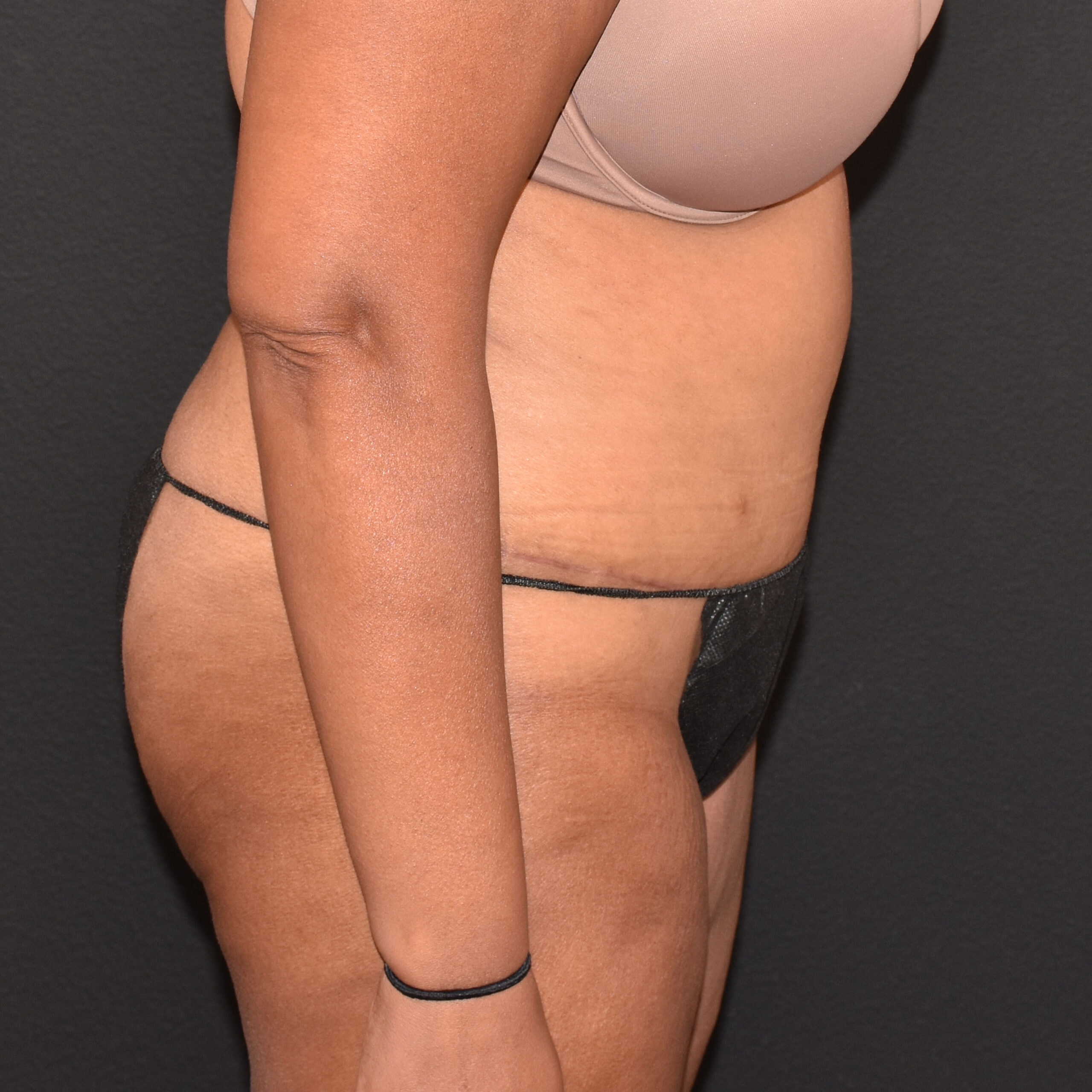 A result from Burgess Plastic Surgery and MedSpa