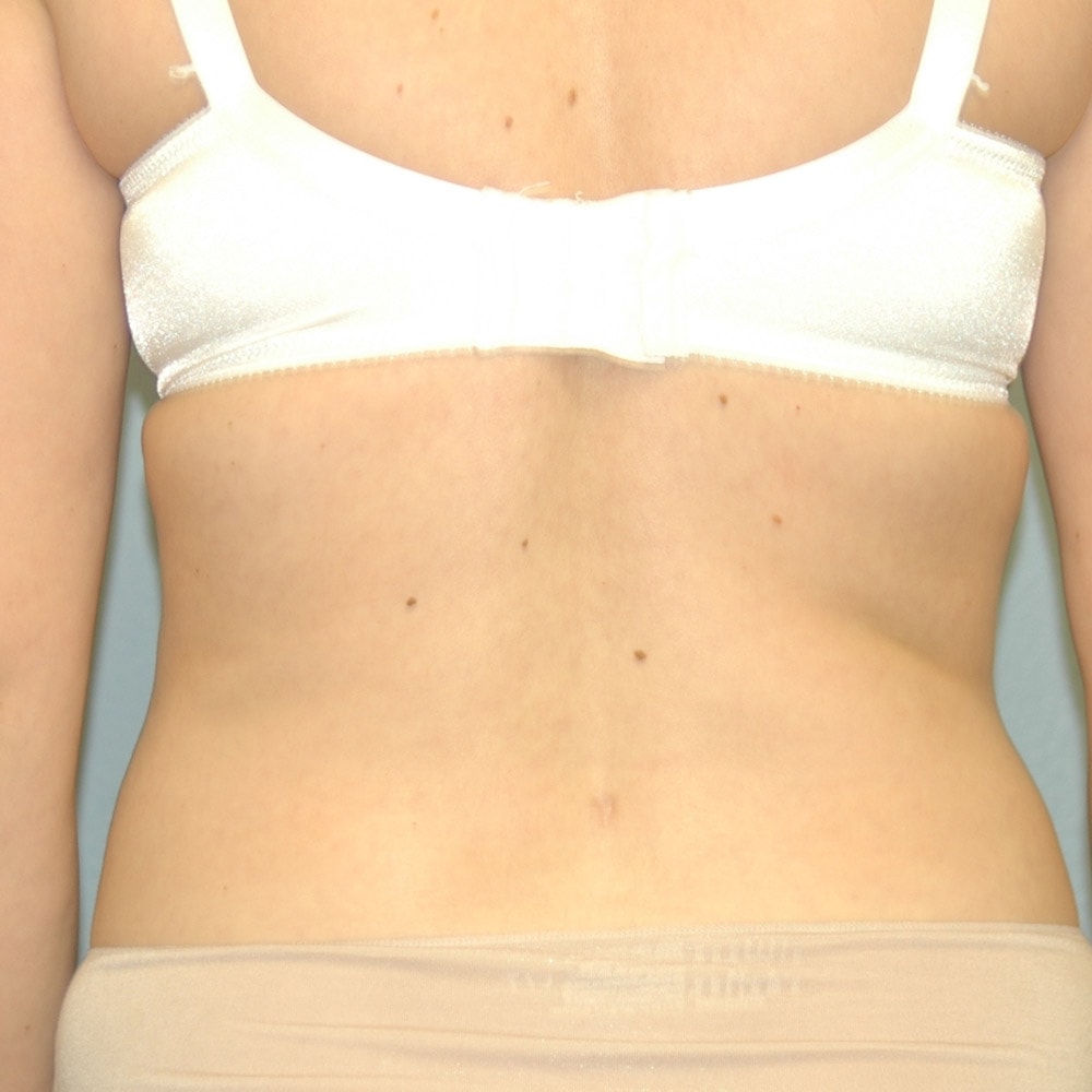 A result from Burgess Plastic Surgery and MedSpa