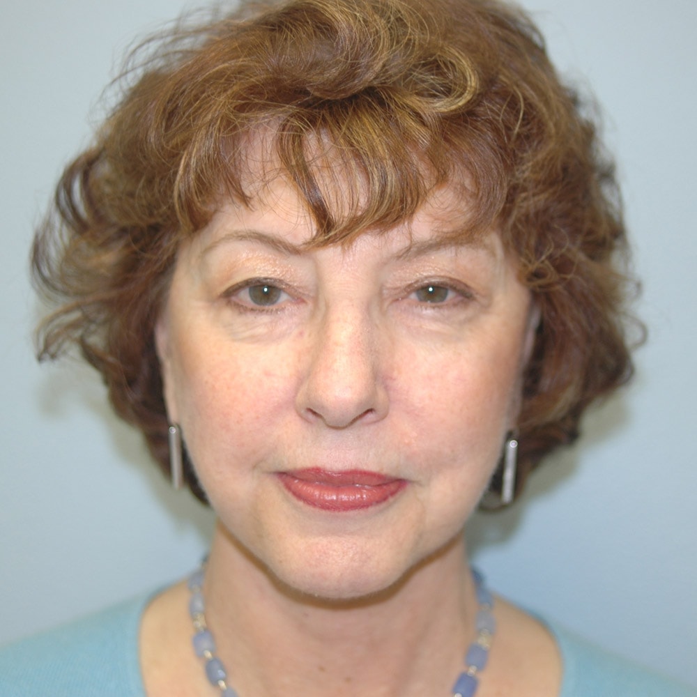 A result from Burgess Plastic Surgery and MedSpa