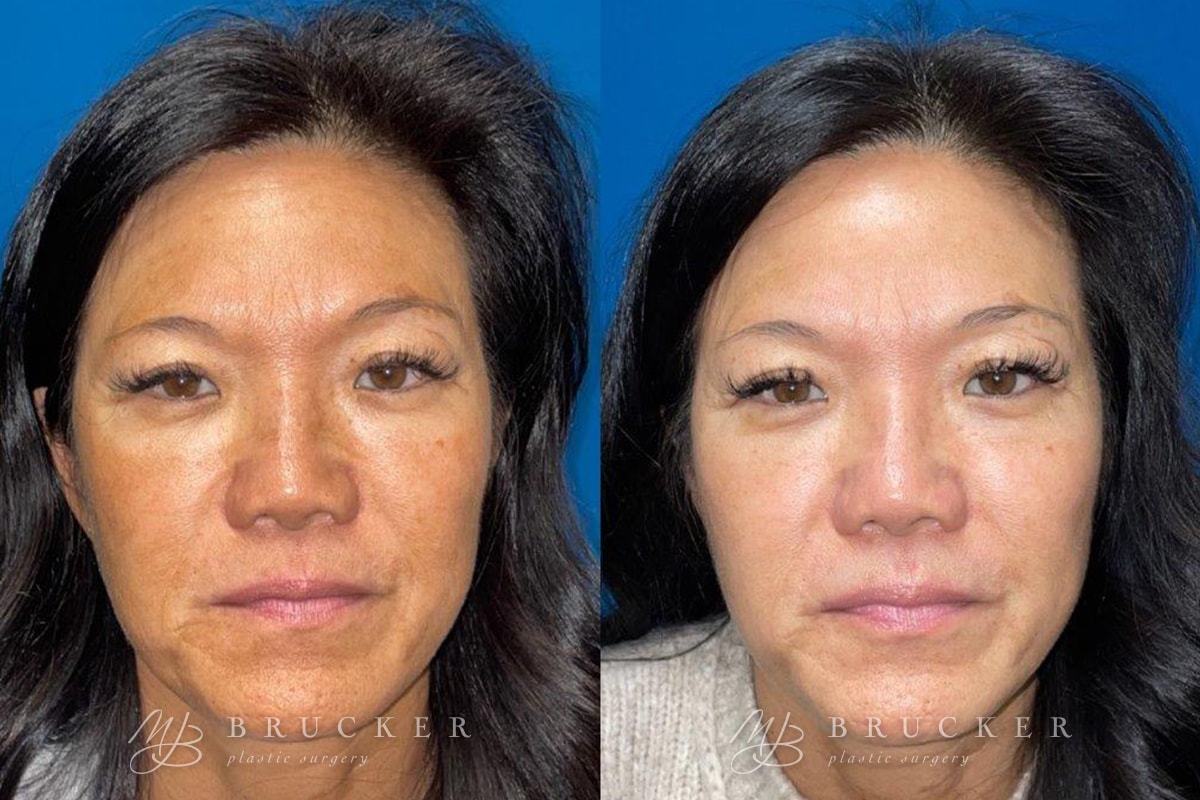 A result from Brucker Plastic Surgery